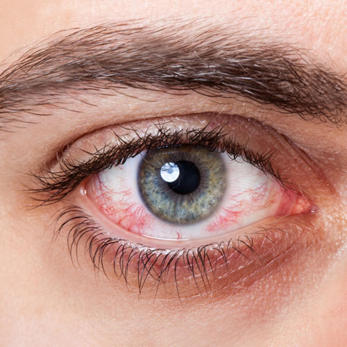 Red eyes Treatment in Oshawa