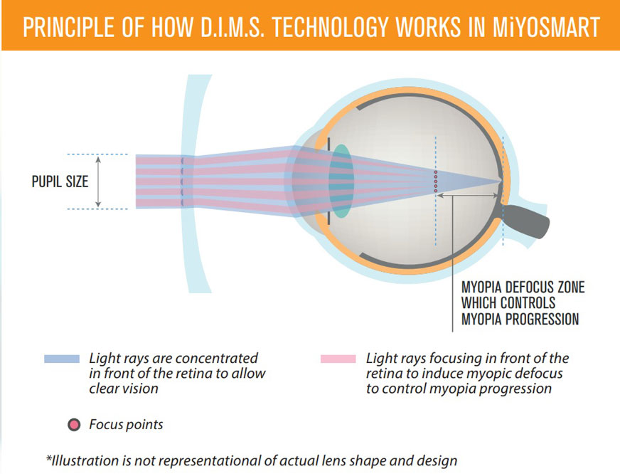 Eye Picture Anatomy Myopia Control