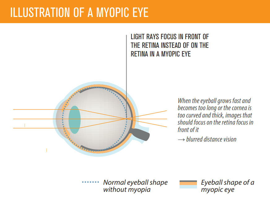 Myopia Eye Picture